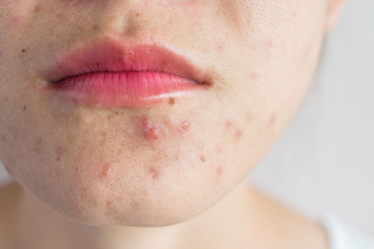 Close up of woman half face with problems of acne inflammation (Papule and Pustule) on her face. Conceptual of problems on woman skin.