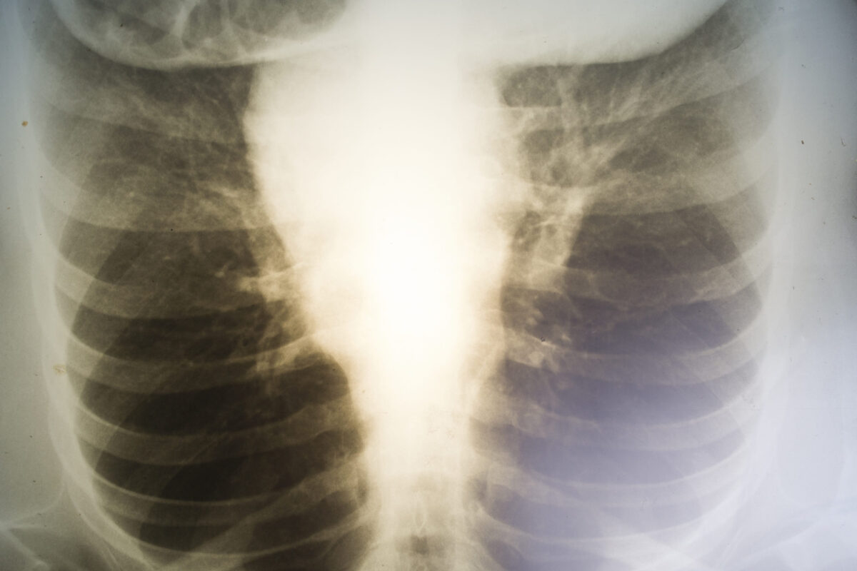 Women's chest x-ray recording of the 80 retro flinging outdated technology
