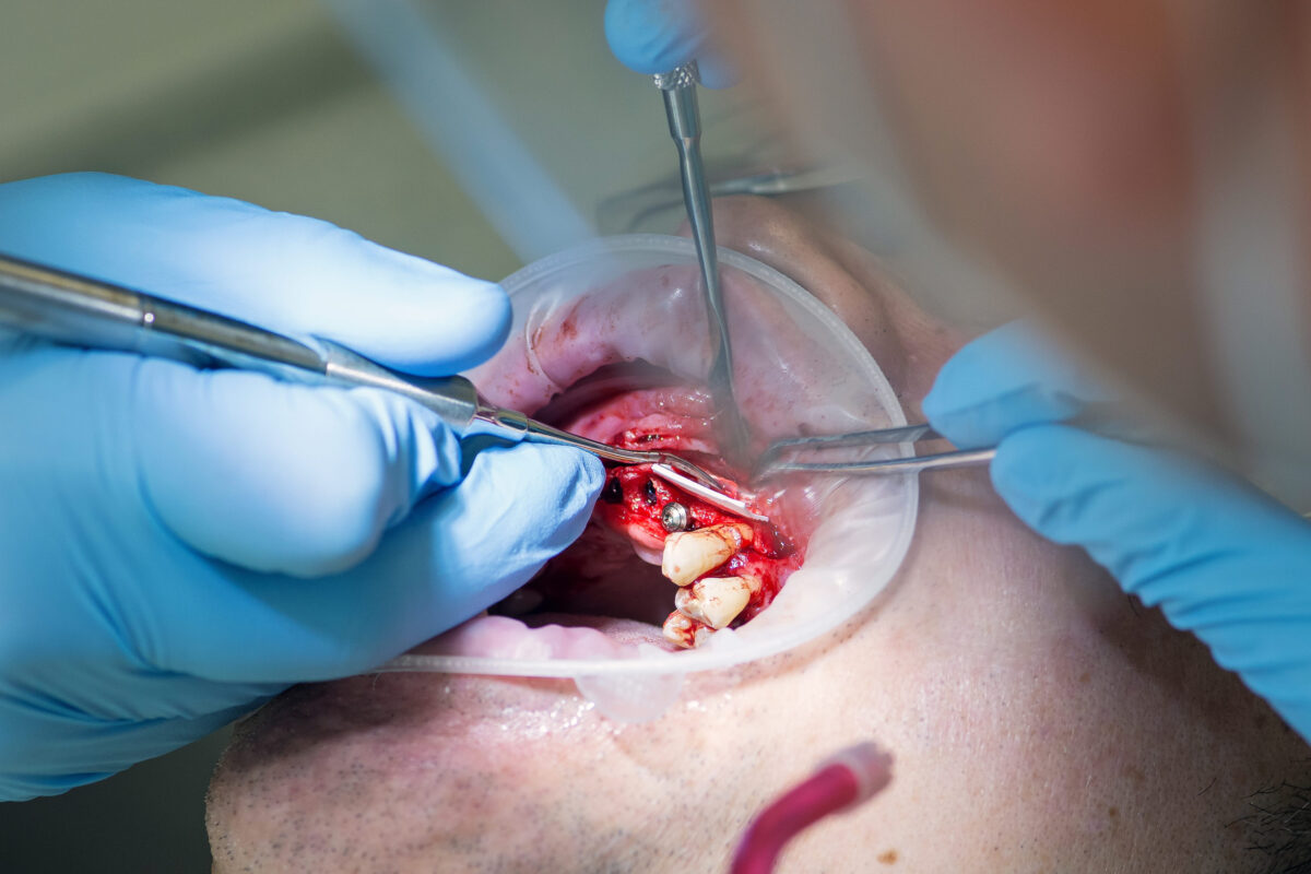 Surgery operation to install four dental implants on the upper jaw. Dental care and treatment. Teeth problems.