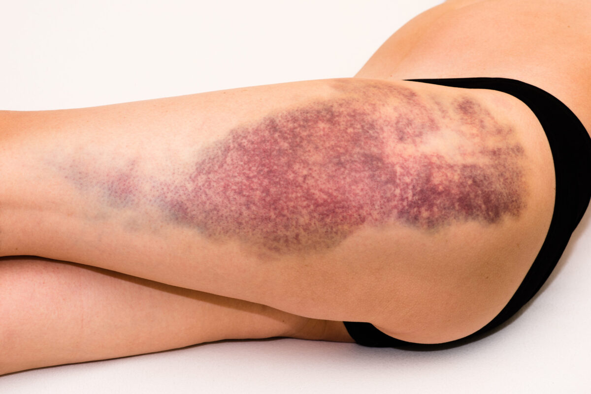 Closeup on a large bruise on wounded woman leg skin laying on white blanket
