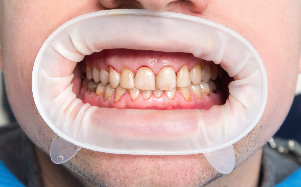 7 Bowel Cancer Warning Signs That May Show Up in Your Mouth, According to Dentists 1 72662774 m