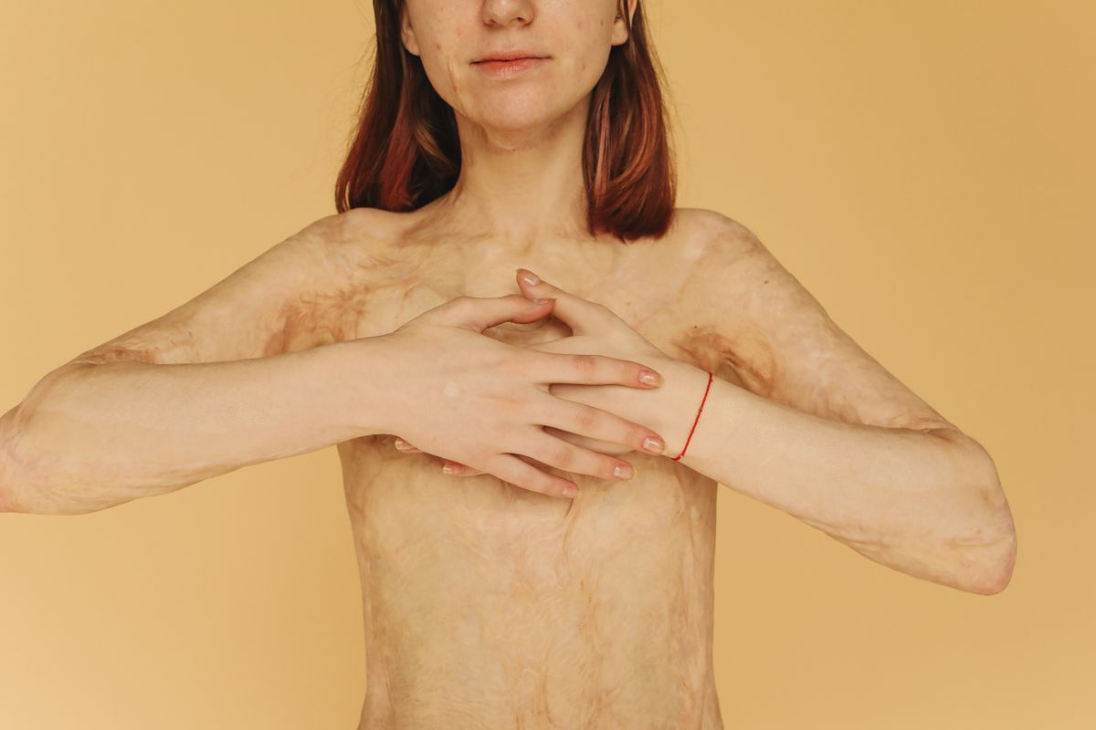 Empowering close-up portrait of a woman with burn scars on a yellow background.