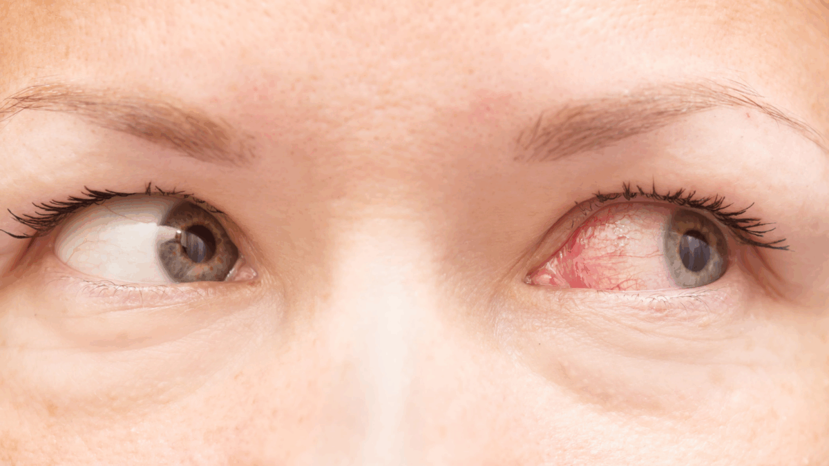 10 Terrifying Eye Conditions That Could Threaten Your Vision 3 eye condition