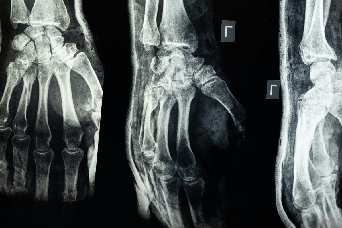 8 Excruciating Pains That Aren’t Caused by Disease But Feel Like It 3 Imaging-of-an-injury-on-the-hand