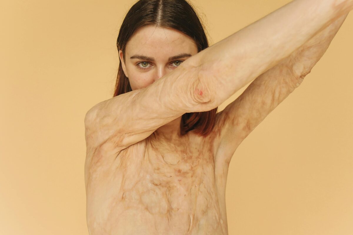 8 Excruciating Pains That Aren’t Caused by Disease But Feel Like It 2 Brunette-woman-shirtless-showing-burned-scars-on-her-body
