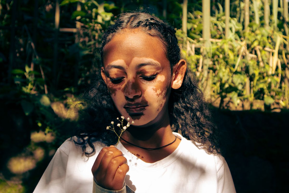 10 Surprising Traits That Can Make You Less Attractive 3 A young Ethiopian woman with vitiligo holds a small flower outdoors, expressing self-reflection.