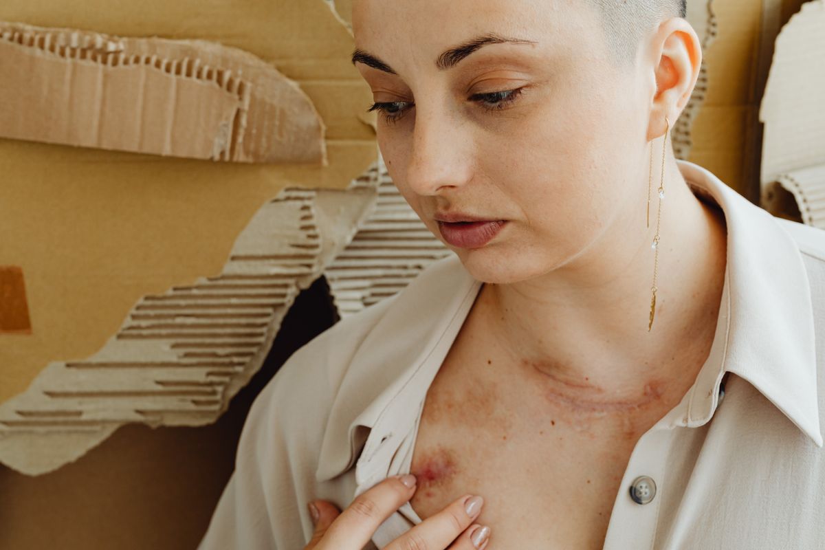 Terrifying Cancer Symptoms People Ignore Until It's Too Late 2 Close-up of a woman showing healing bruises on her chest with a thoughtful expression.