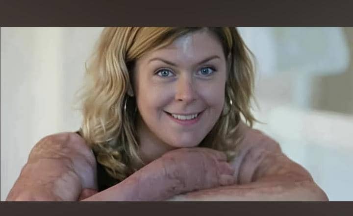 Swedish Mother Emma Schols Ran Into A Burning House To Save Her Six Children And Survived A 93% Burn Injury.